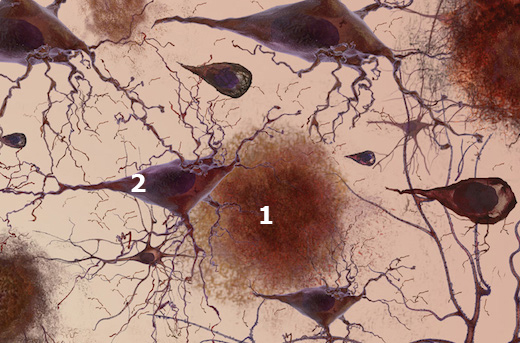 neuronas enfermas