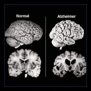 daño cerebral en alzheimer