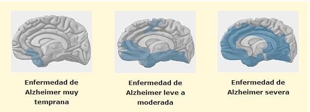 progresion del alzheimer